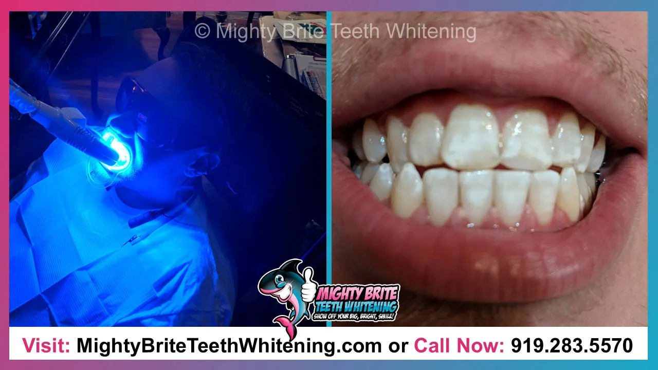 29650 professional teeth whitening