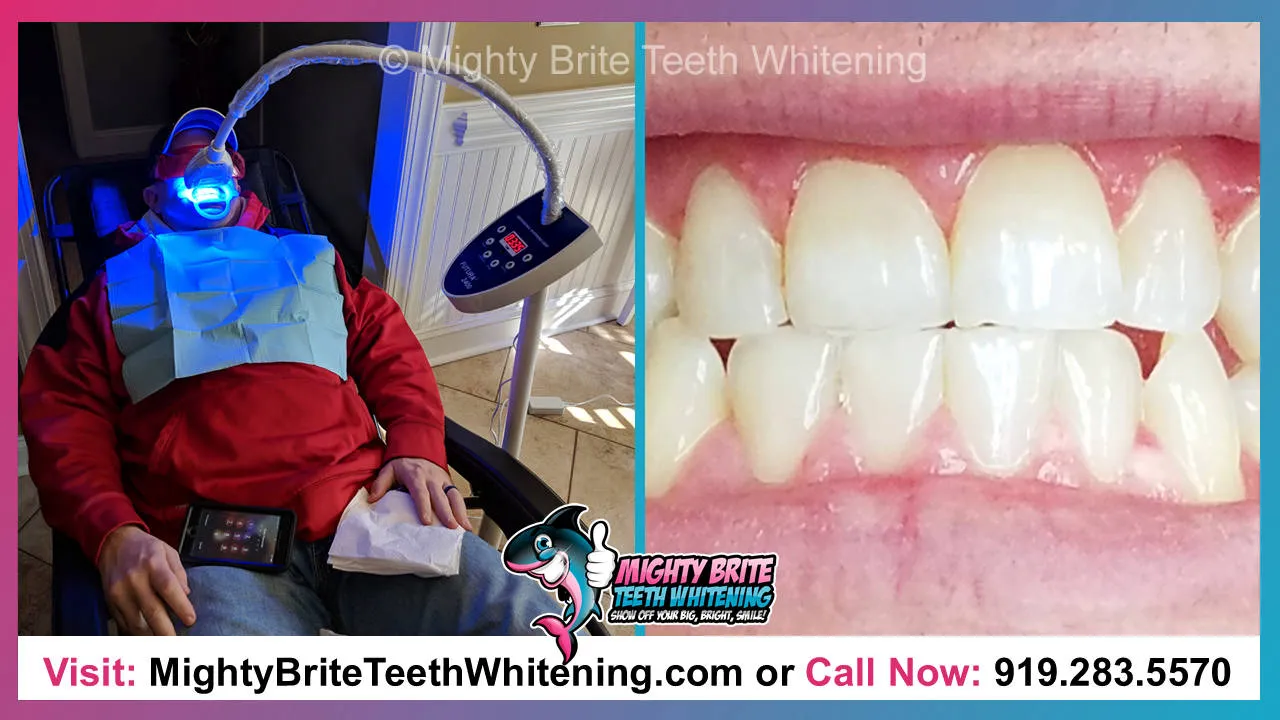 29650 raleigh teeth whitening before after