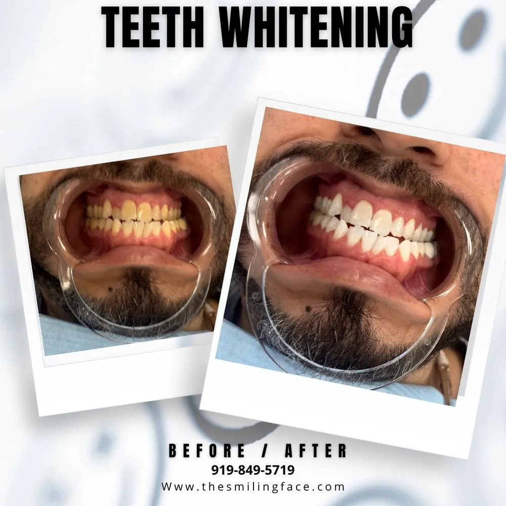 /img/29650-teeth-whitening-cost.webp