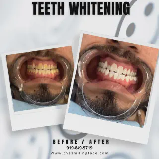 /img/29650-teeth-whitening-cost.webp