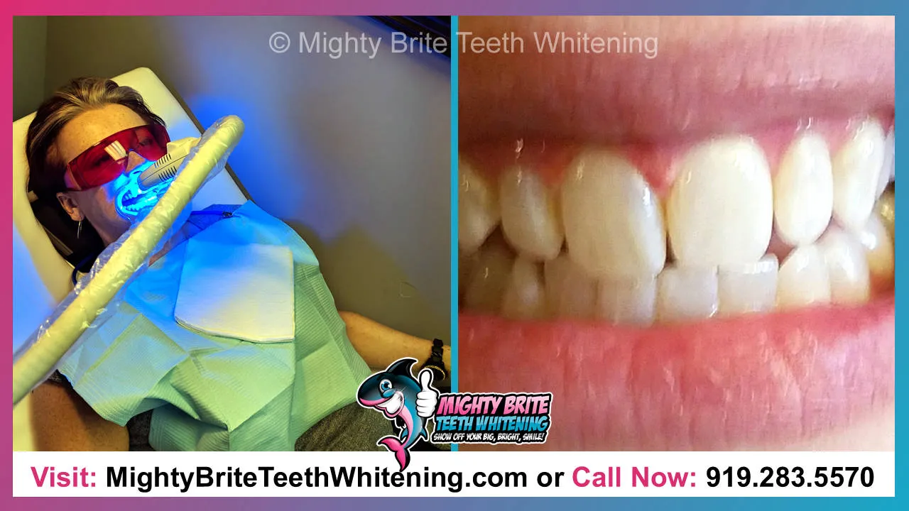 29650 teeth whitening diet
