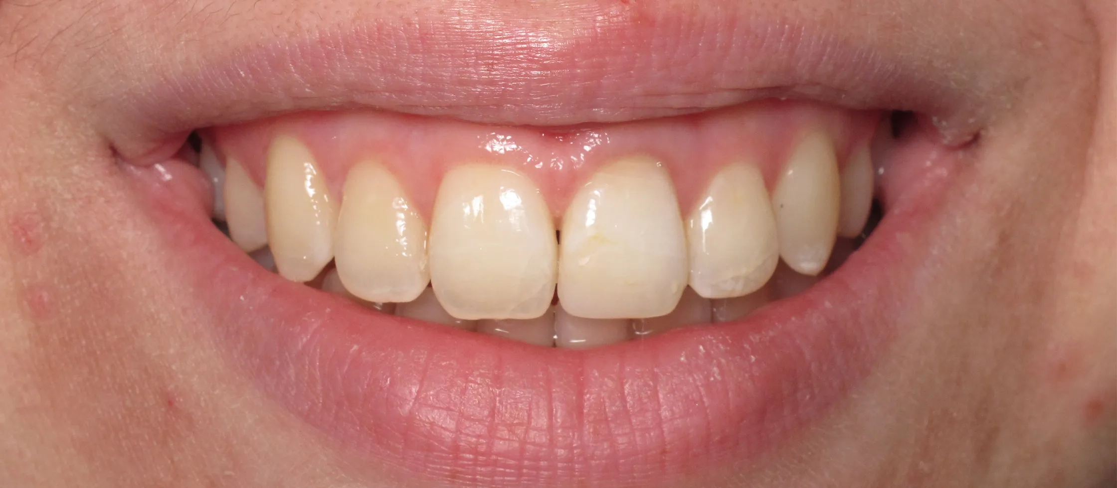 29651 flash teeth whitening minnesota avoid staining foods