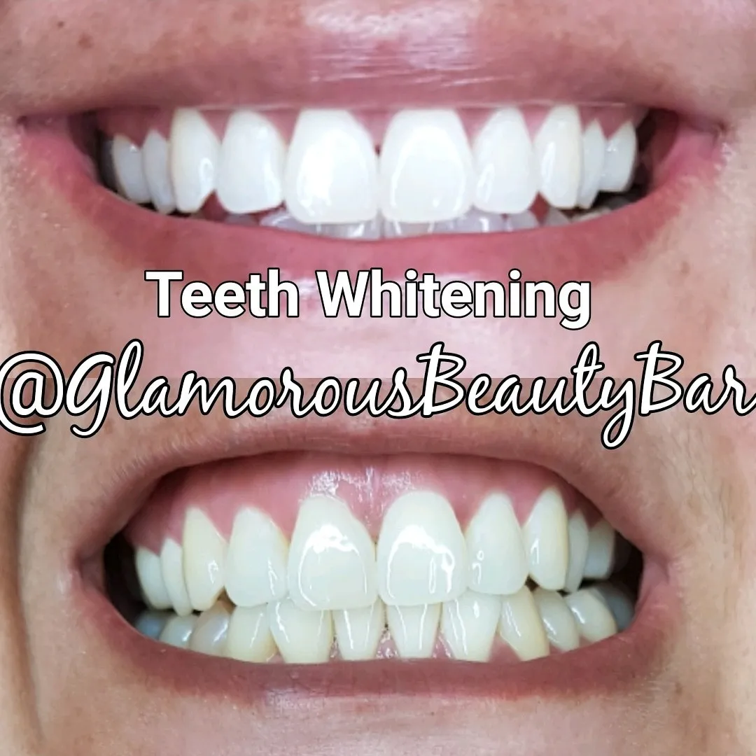 29651 flash teeth whitening minnesota before after