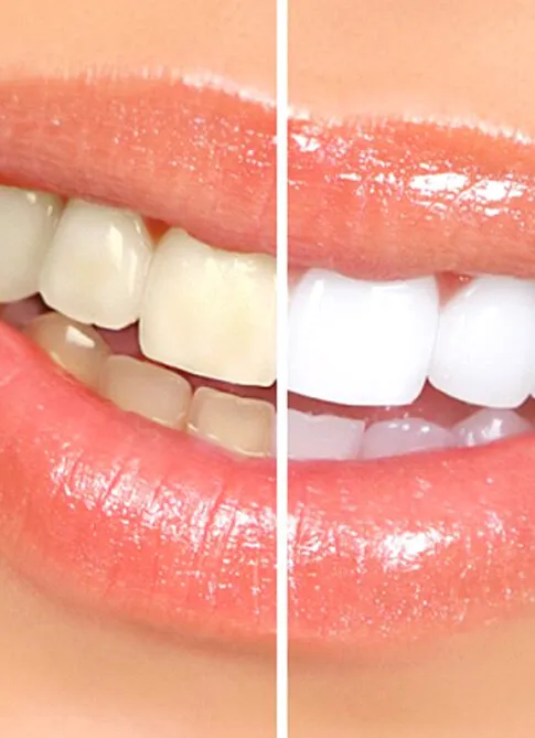 29651 flash teeth whitening minnesota dentist consultation