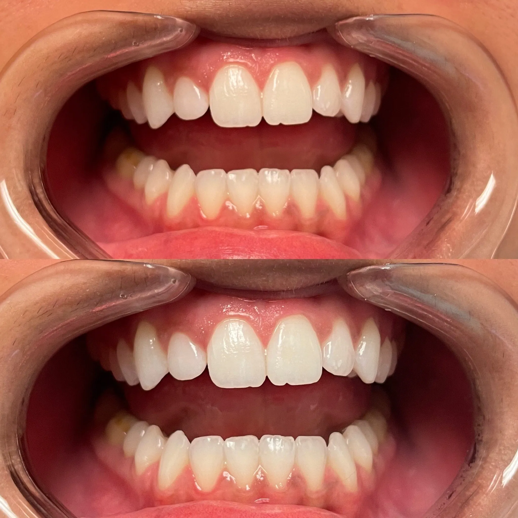 29651 flash teeth whitening minnesota procedure
