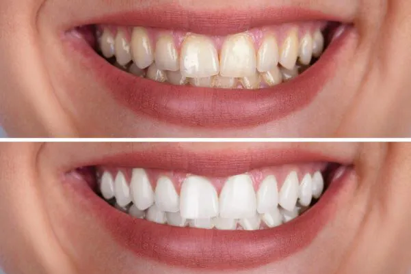 29651 flash teeth whitening minnesota teeth sensitivity