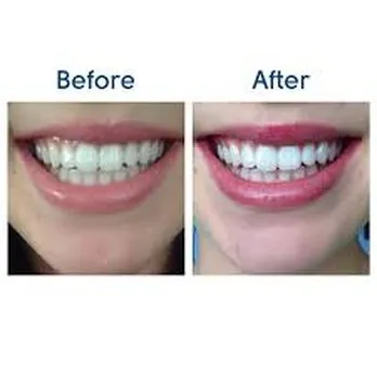 29655 teeth whitening comparison