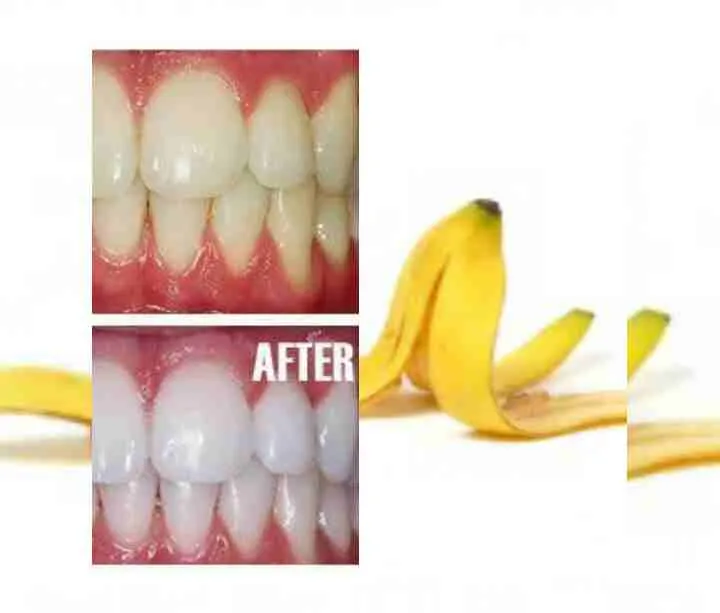 29665 banana peel teeth whitening 6