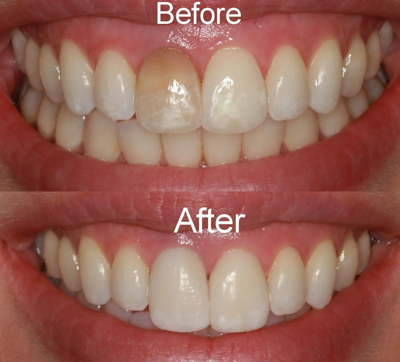 29666 whitening strips