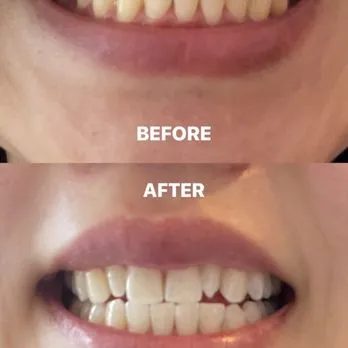 29668 at home teeth whitening kit