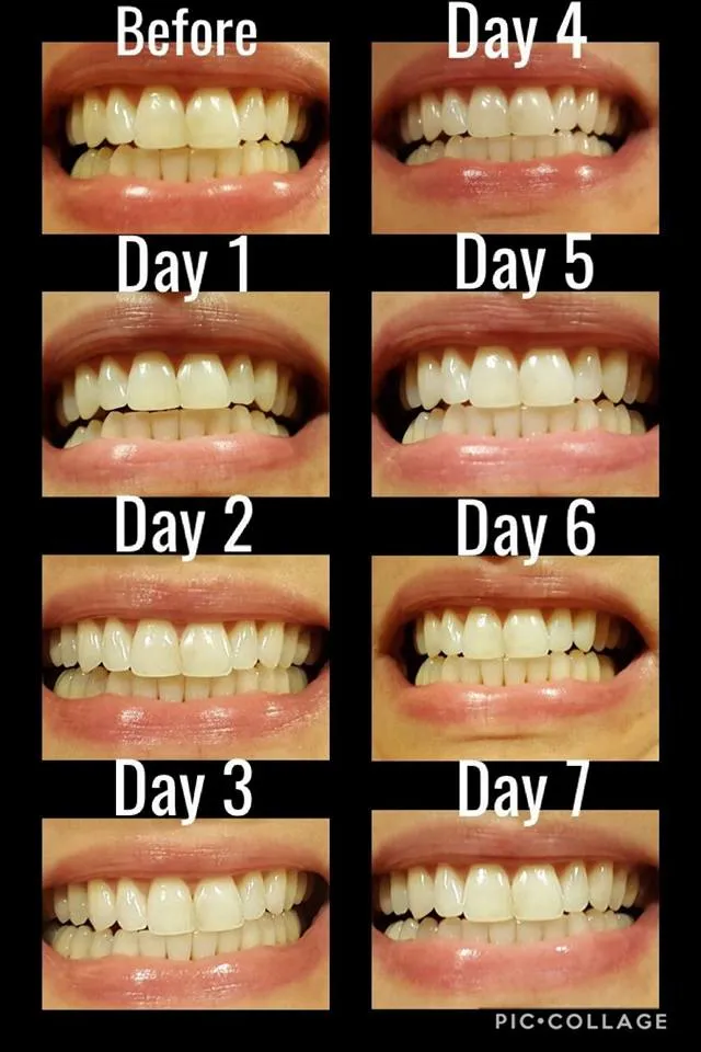 29673 brushing after whitening