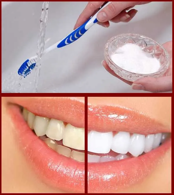 29685 teeth whitening hydrogen peroxide