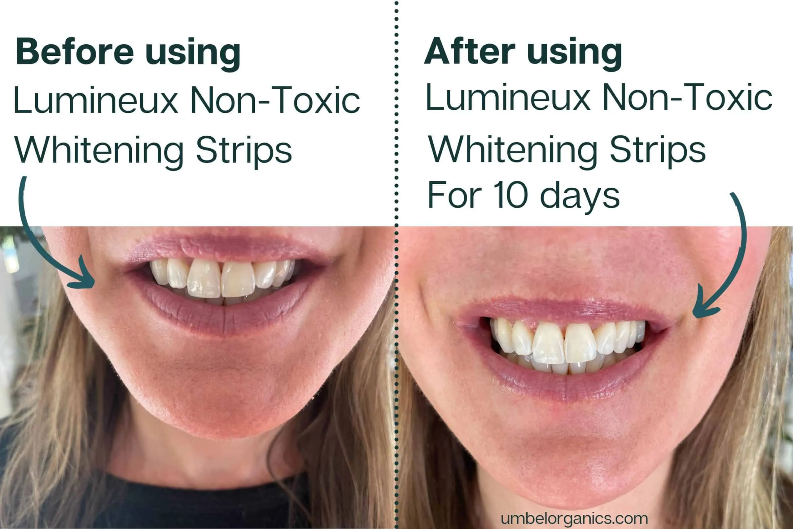 29691 applying whitening strips