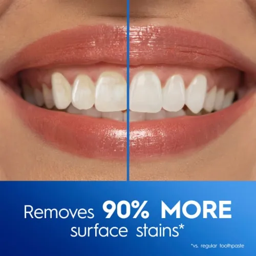 29693 arctic white teeth whitening belfast before after