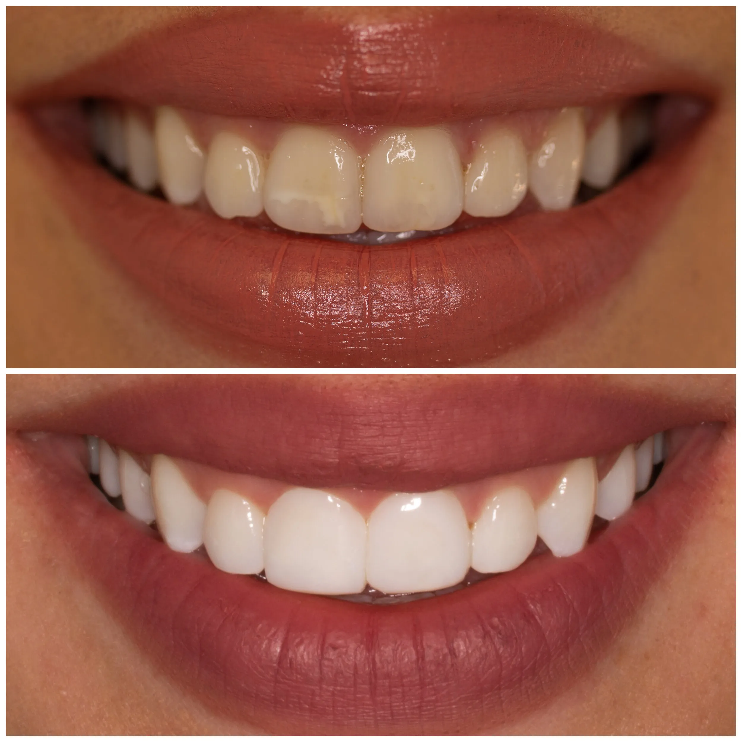 29693 arctic white teeth whitening belfast confident smile