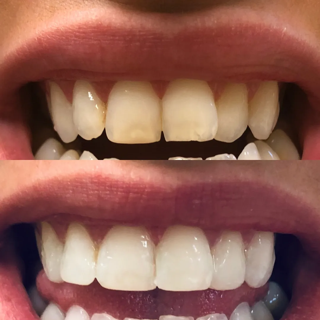 29693 arctic white teeth whitening belfast procedure