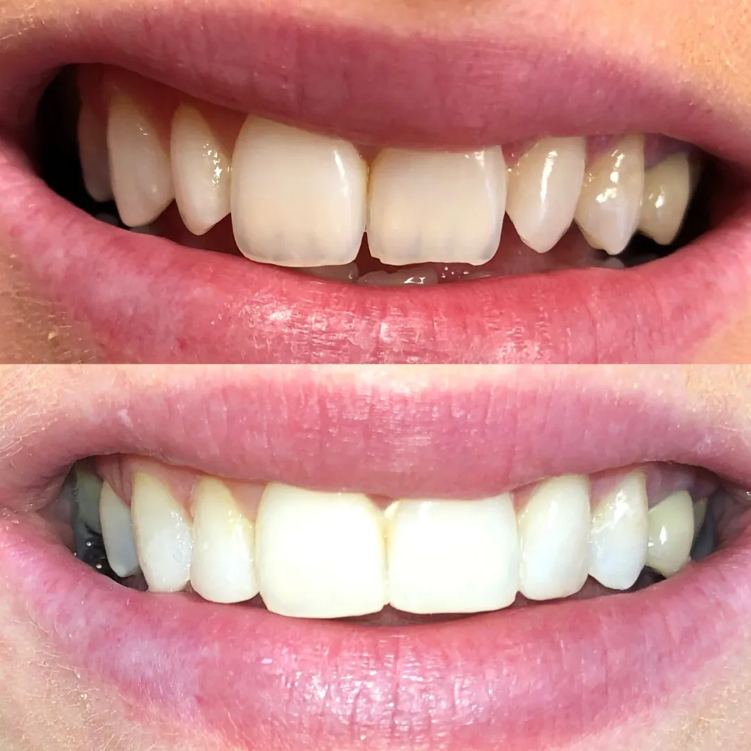 29693 arctic white teeth whitening belfast professional care