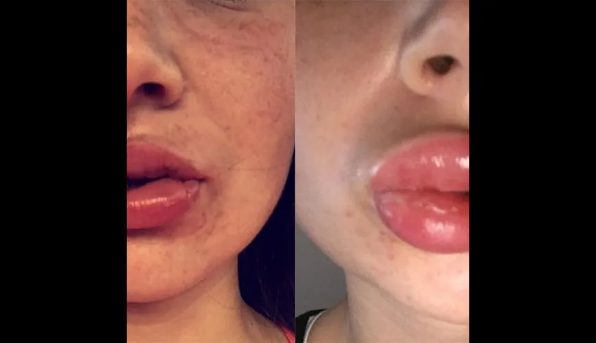 29703 gum irritation