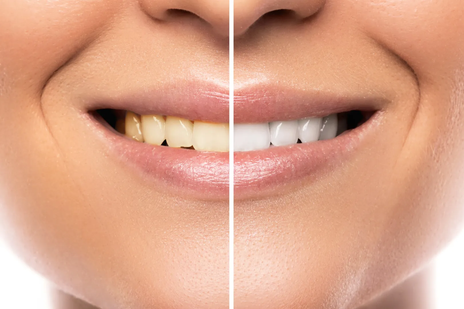 29705 beverly hills tooth whitening image6