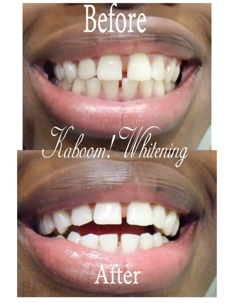 29707 diy teeth whitening methods