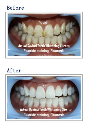 29710 da vinci teeth whitening location 2