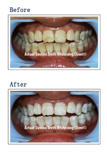 29710 da vinci teeth whitening location 3