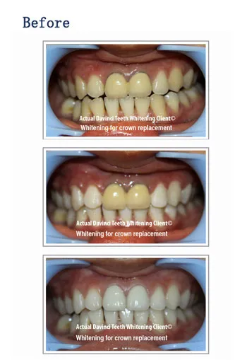 29710 da vinci teeth whitening location 4