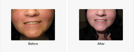 29712 studio city teeth whitening confidence