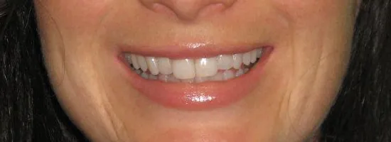 29712 teeth whitening long lasting results