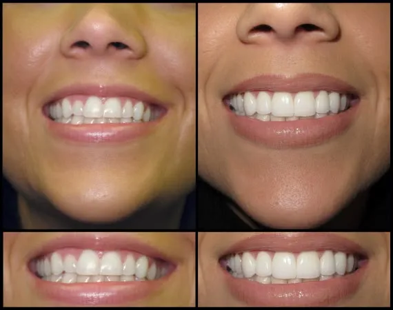 29712 teeth whitening professional treatment