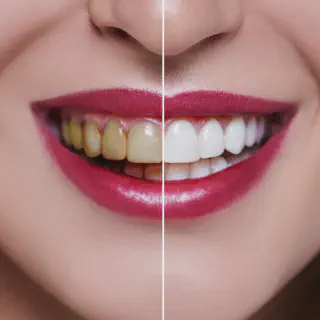 /img/29715-professional-whitening.webp