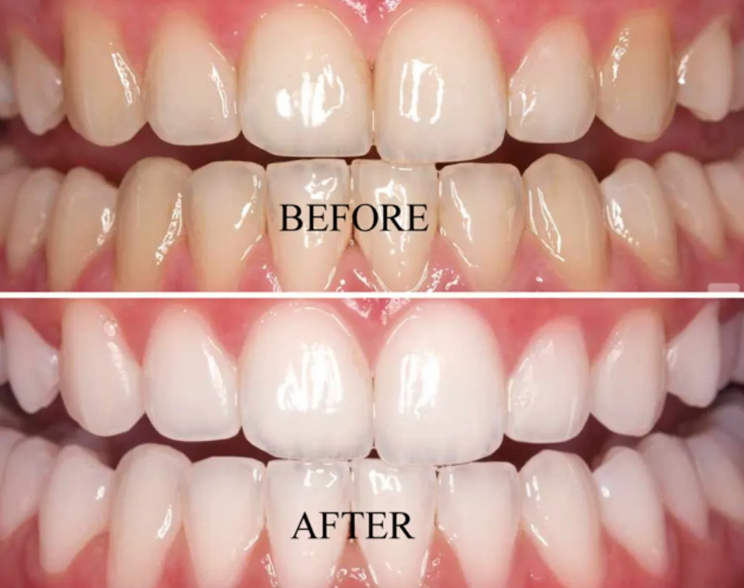 29715 tooth sensitivity