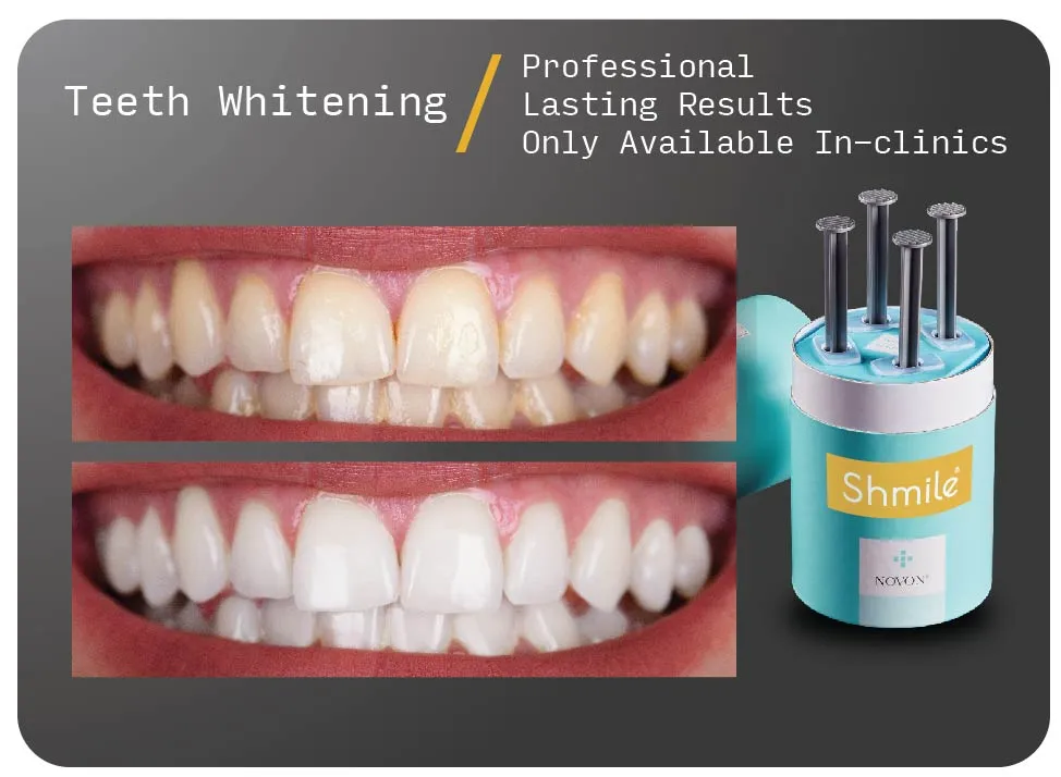 29716 tooth whitening kent image1