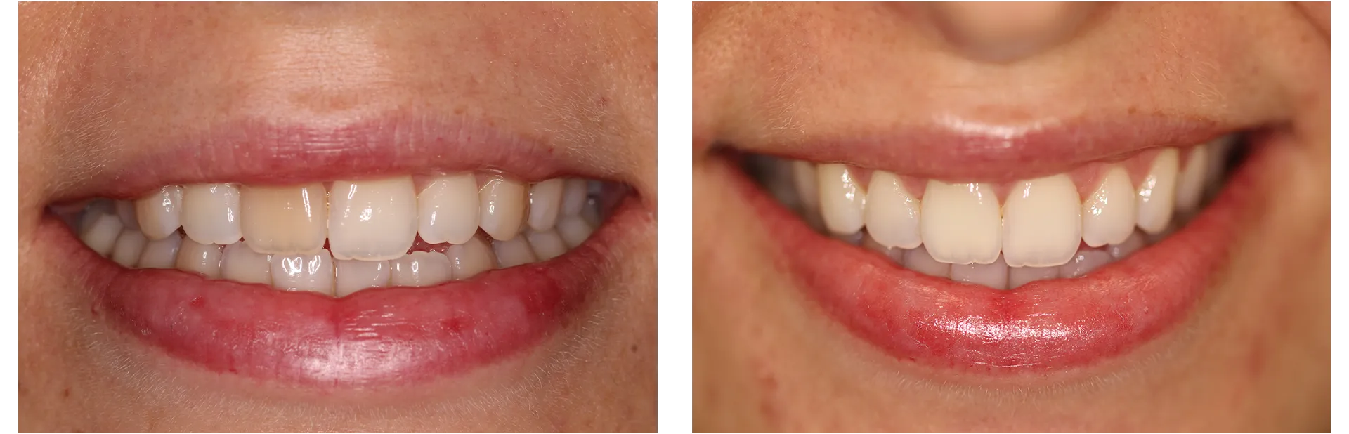 29716 tooth whitening kent image3