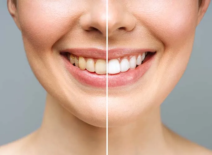 29716 tooth whitening kent image4