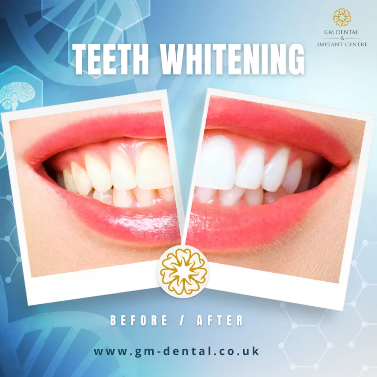 29716 tooth whitening kent image5