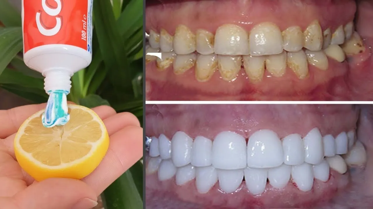 29719 at home teeth whitening kit