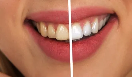 29721 baking soda teeth whitening brushing