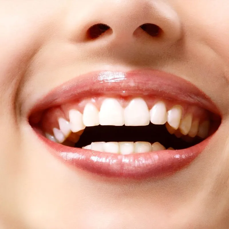29723 teeth whitening coquitlam bc image1