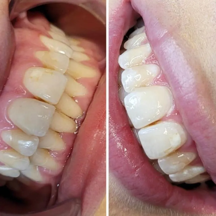 29723 teeth whitening coquitlam bc image4