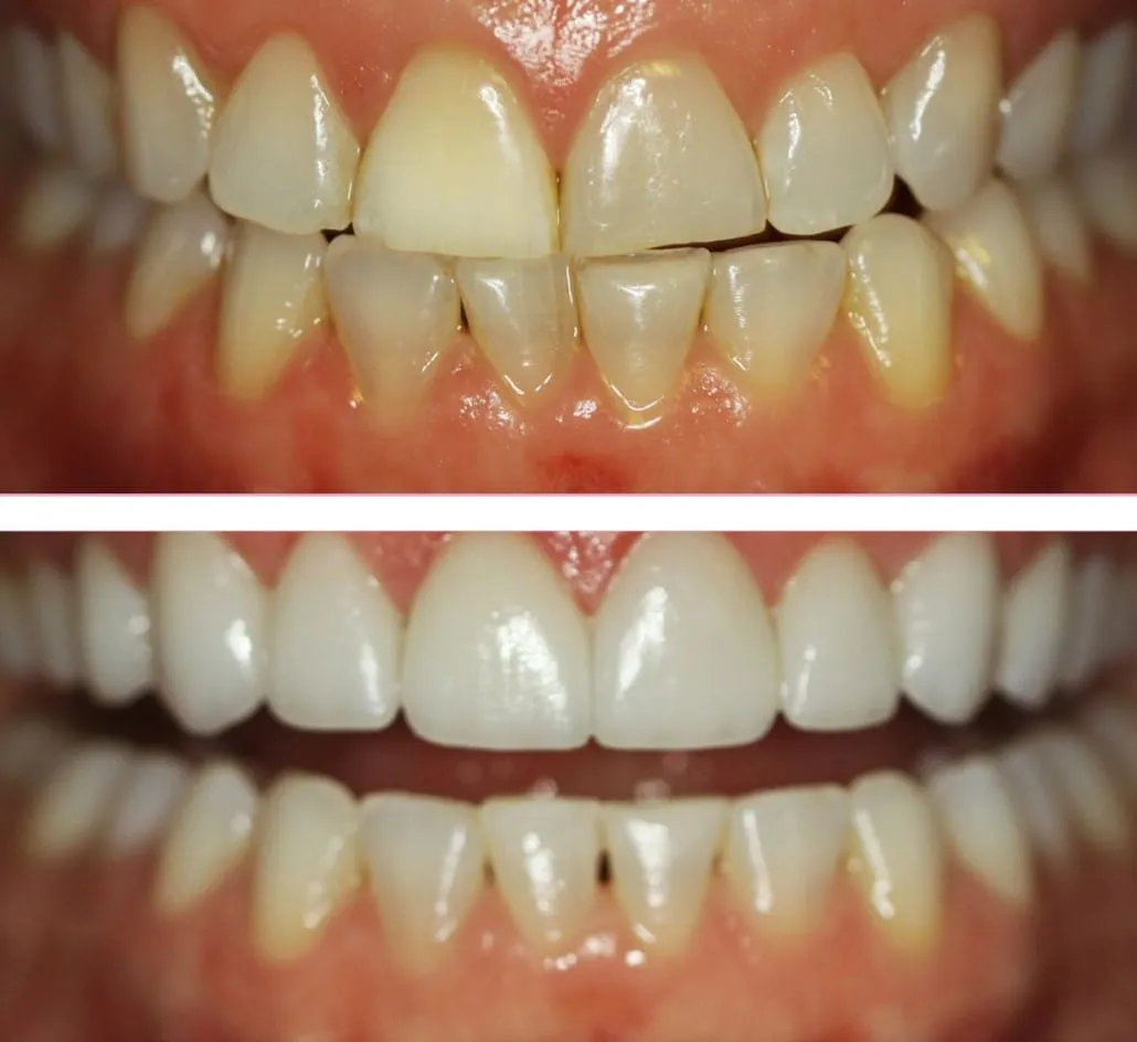 29723 teeth whitening coquitlam bc image6