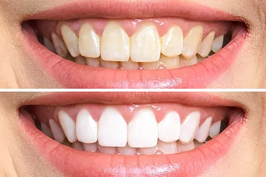 29724 stained teeth causes