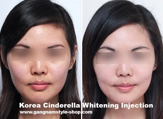 29729 whitening injection germany cost