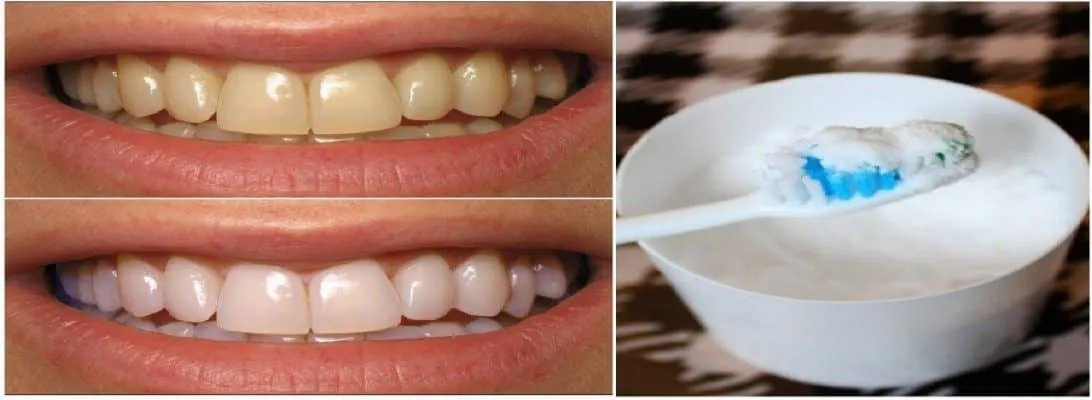 29730 teeth whitening brush