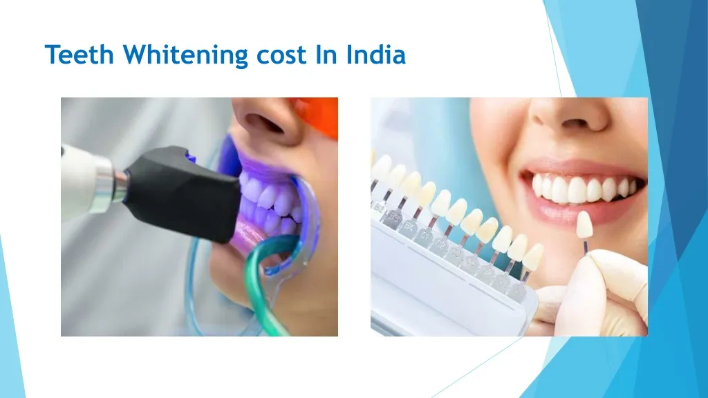 29740 home teeth whitening kit