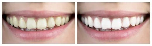 29746 in office teeth whitening