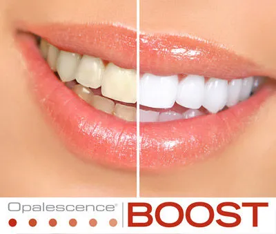 29749 in office teeth whitening