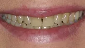 29749 tooth discoloration causes