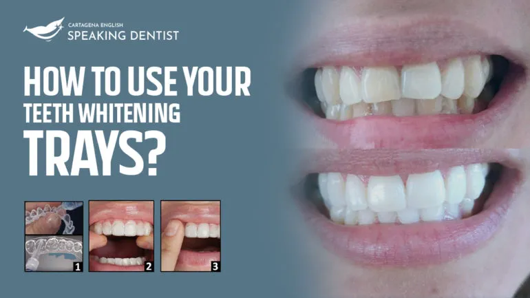 29753 custom whitening trays