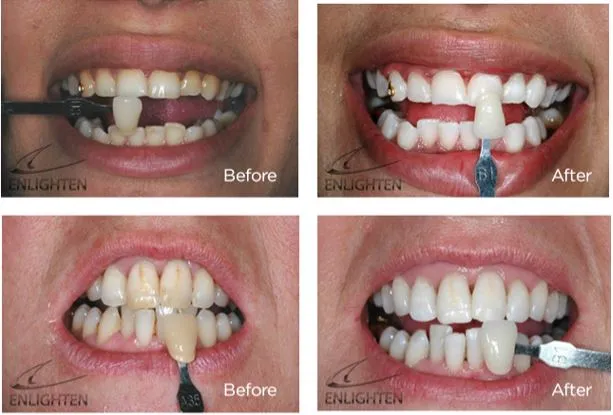 29753 tooth sensitivity whitening